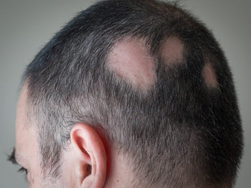 دلایل و درمان ریزش مو سکه‌ای-خانومی