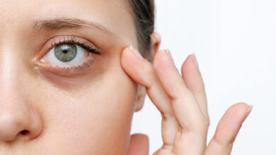 علت و روش رفع و درمان سیاهی دور چشم