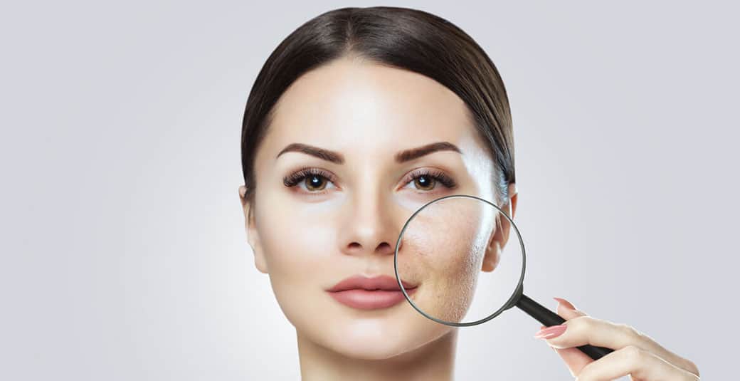 بهترین روش درمان منافذ باز پوست صورت