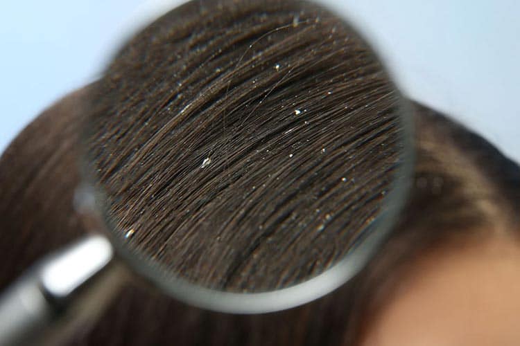 شوره سر | علت و درمان شوره مو (به 10 روش خانگی و دارویی)